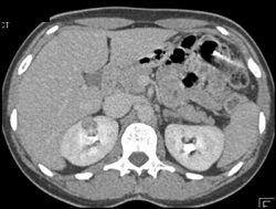 1 Cm Renal Cell Carcinoma - CTisus CT Scan