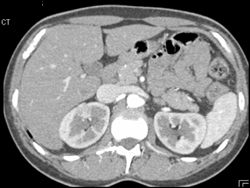 1 Cm Right Renal Cell Carcinoma at 11 O'clock - CTisus CT Scan