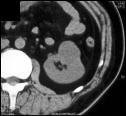 Renal Cell Carcinoma - CTisus CT Scan