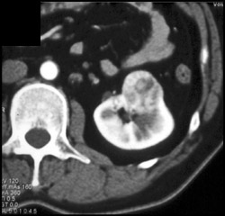 Renal Cell Carcinoma - CTisus CT Scan