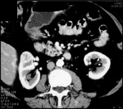 Renal Cell Carcinoma - CTisus CT Scan