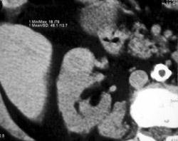 Renal Cell Carcinoma (hiding on C-m Phase Image) - CTisus CT Scan