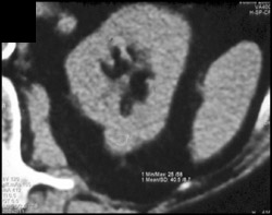 High Density Renal Cyst - CTisus CT Scan