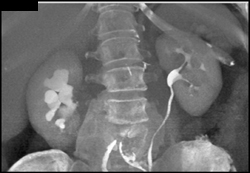 Transitional Cell Carcinoma - CTisus CT Scan