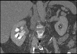 Transitional Cell Carcinoma - CTisus CT Scan