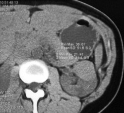 High Density Renal Cyst - CTisus CT Scan