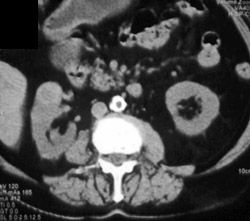 Renal Cell Carcinoma (right) - CTisus CT Scan