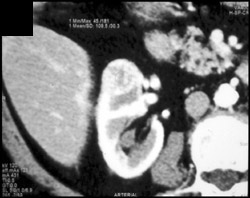 Renal Cell Carcinoma - CTisus CT Scan