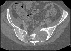 Metastatic Renal Cell Carcinoma to Bone - CTisus CT Scan