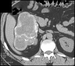 Renal Cell Carcinoma - CTisus CT Scan