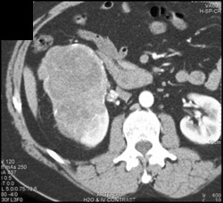 Agressive Renal Cell Carcinoma - CTisus CT Scan