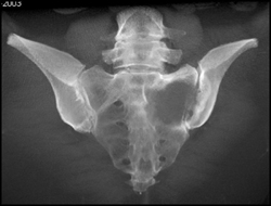 Metastatic Renal Cell Carcinoma to Sacrum - CTisus CT Scan