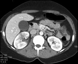 Acute Pyelonephritis - CTisus CT Scan