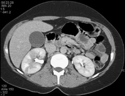 Acute Pyelonephritis - CTisus CT Scan