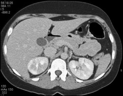 Acute Pyelonephritis - CTisus CT Scan