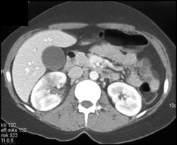 Acute Pyelonephritis - CTisus CT Scan