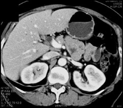 Incidental Clot in Left Renal Vein - CTisus CT Scan