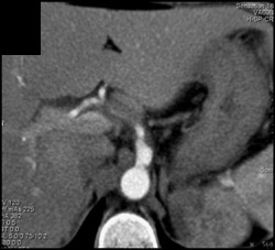 Renal Infarct - CTisus CT Scan