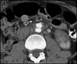 Renal Infarct - CTisus CT Scan