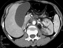 Renal Infarction - CTisus CT Scan