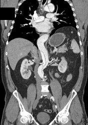 Aortic Dissection Involves the Left Renal Artery - CTisus CT Scan