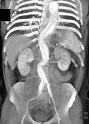 Decreased Left Renal Enhancement Due to Dissection - CTisus CT Scan