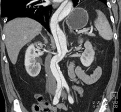 Aortic Dissection Involves the Renal Artery - CTisus CT Scan