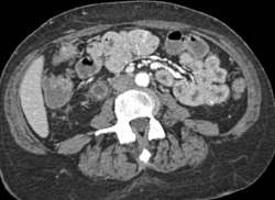 Thrombosed Gonadal Vein - CTisus CT Scan