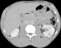 High Density Renal Cyst - CTisus CT Scan