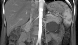 Ureteropelvic Junction (UPJ) Due to Crossing Artery - CTisus CT Scan