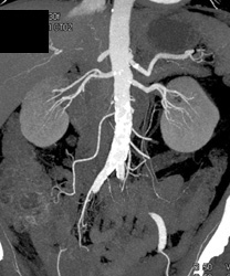 Prehilar Branching of Right Renal Artery - CTisus CT Scan