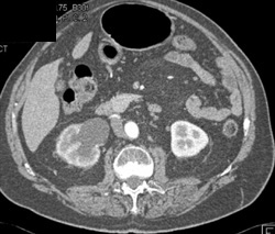 Inflammation of Right Ureter - CTisus CT Scan