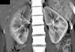 Abscess Right Kidney - CTisus CT Scan