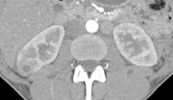 Acute Pyelonephritis With Right Renal Abscess - CTisus CT Scan