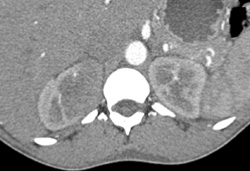 Acute Pyelonephritis - CTisus CT Scan