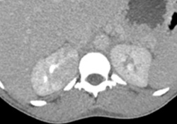 Acute Pyelonephritis With Renal Abscess - CTisus CT Scan