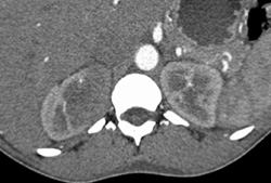 Acute Pyelonephritis - CTisus CT Scan