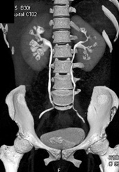 Dilated Right Renal Calyces and Left Medullary Sponge Kidney - CTisus CT Scan