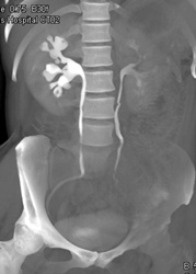 Dilated Right Renal Calyces - CTisus CT Scan