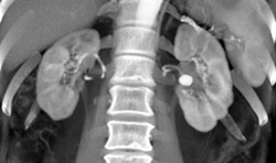 Left Renal Pelvis Stone - CTisus CT Scan