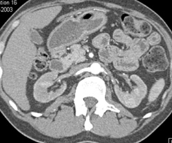 Poorly Enhancing Kidney - CTisus CT Scan