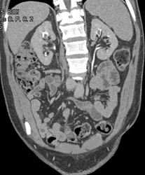 Pseudolesion in Calyx - CTisus CT Scan