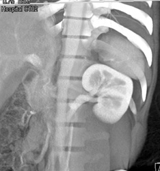 Retroaortic Renal Vein - CTisus CT Scan