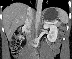 Retroaortic Renal Vein - CTisus CT Scan