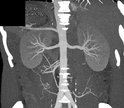 Normal Renal Arteries - CTisus CT Scan