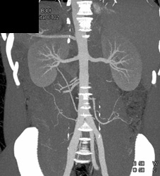 Normal MIP Renal Arteries - CTisus CT Scan