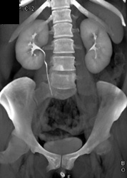 Normal CT Urogram - CTisus CT Scan