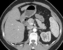 Small Left Upper Pole Renal Artery - CTisus CT Scan