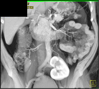 Pelvic Kidney in Potential Renal Donor - CTisus CT Scan