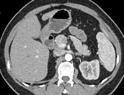 Small Accessory Renal Artery - CTisus CT Scan